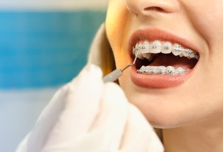 braces, dental, orthodontics
